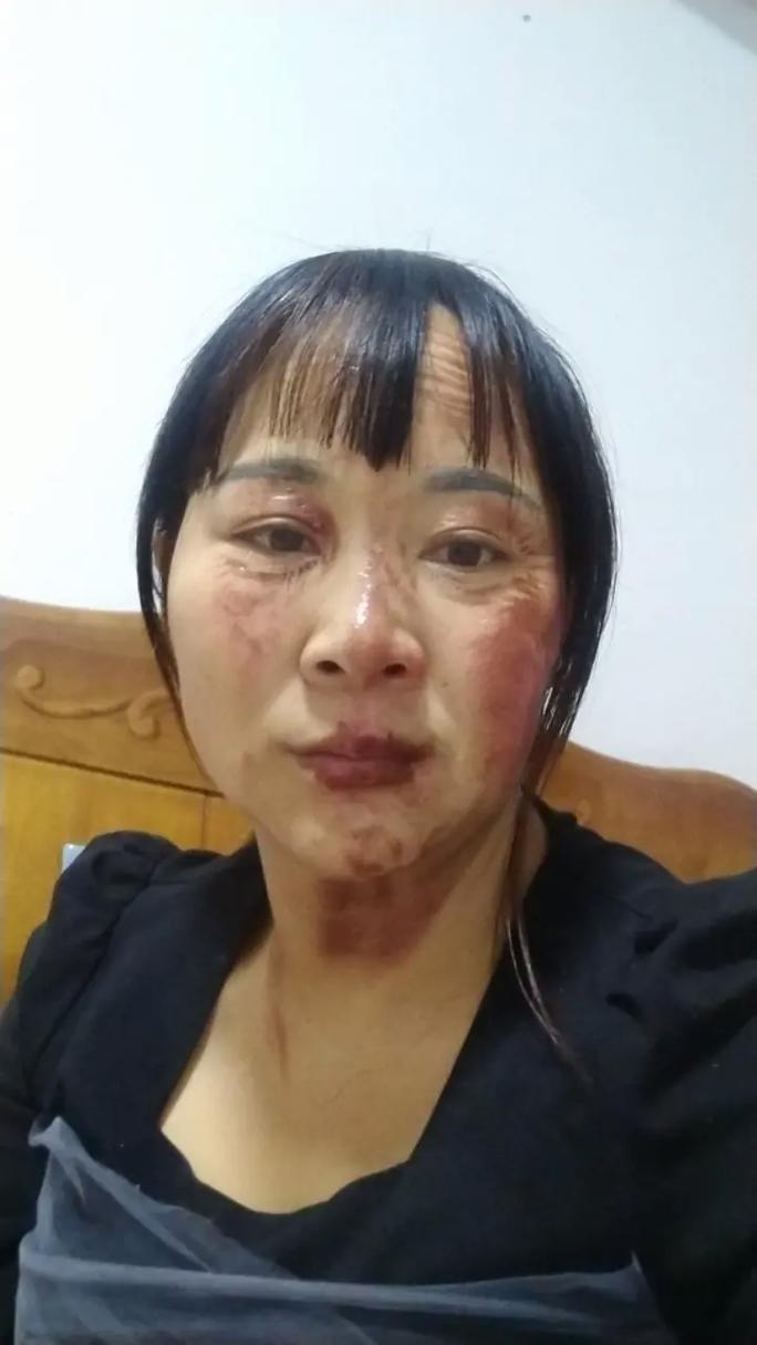 你见过最惨无人道的事情是什么烧伤妈妈术后说话有影响吗烧伤妈妈术后说话